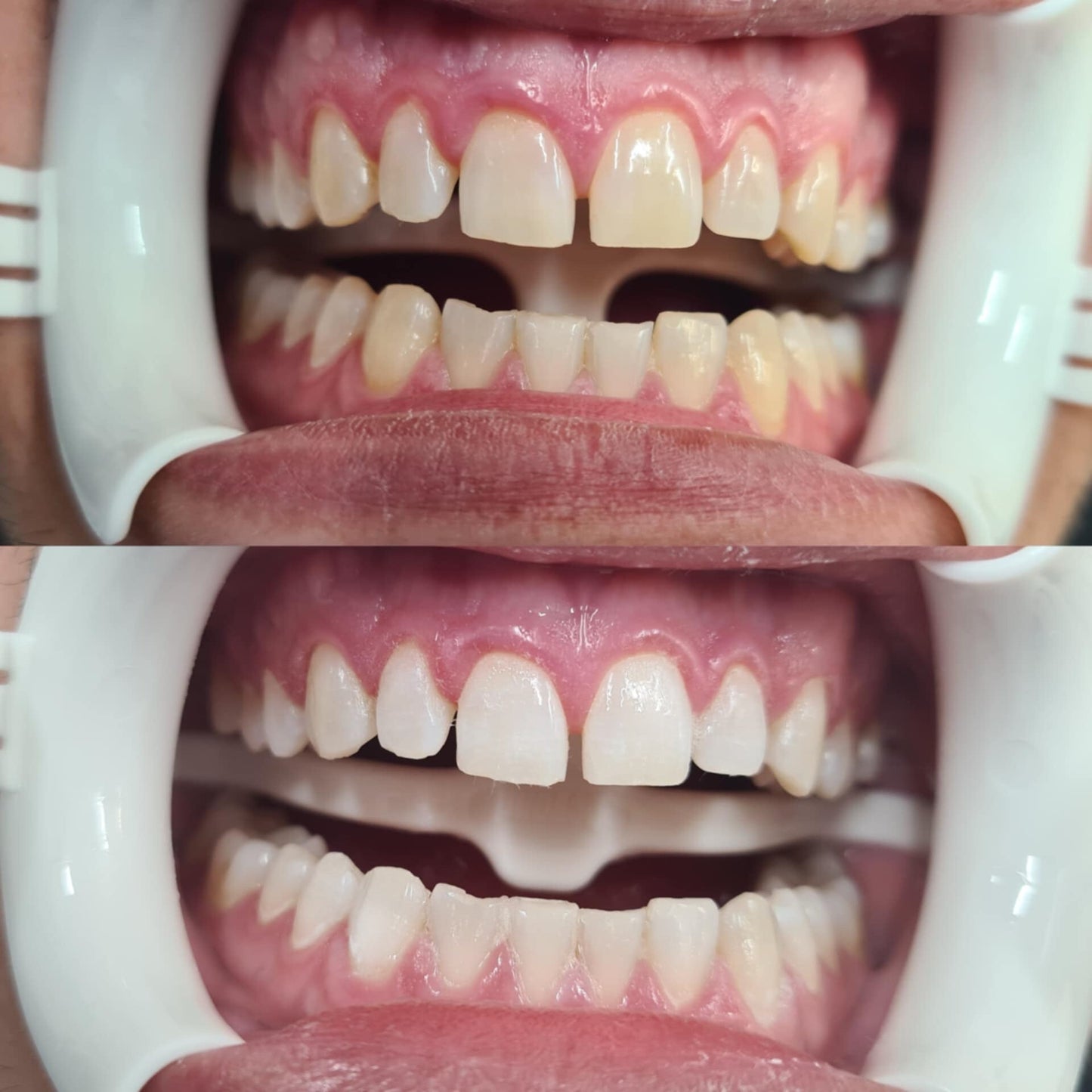 Teeth whitening - Blink & InkBlink & InkBlink & Ink